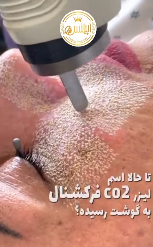 لیزر فرکشنال co2