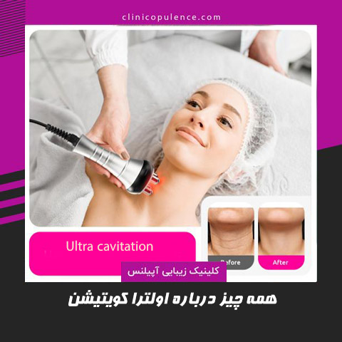 اولترا کویتیشن لاغری در کرج تخفیف