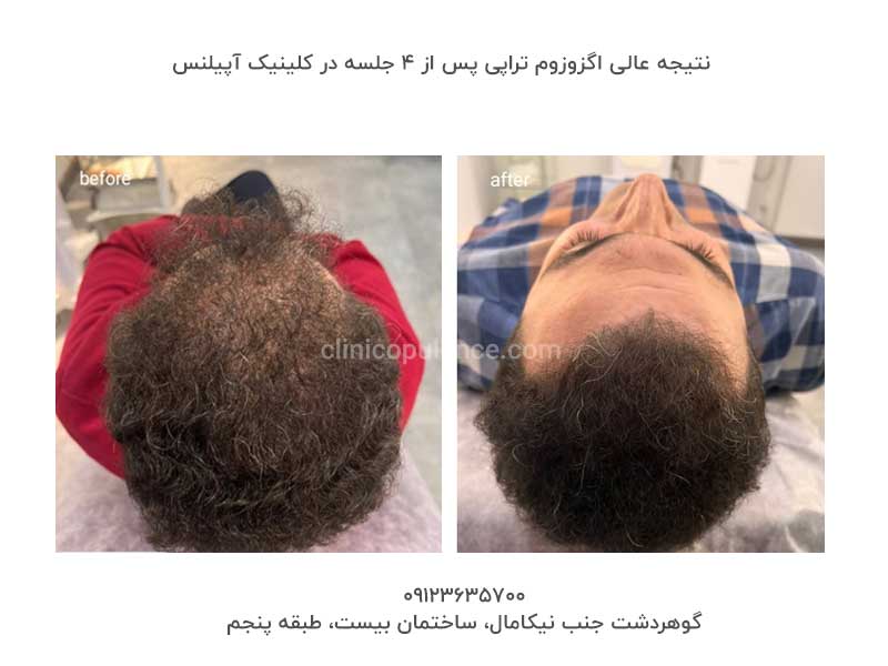 اگزوزوم تراپی مو سلول بنیادی در کرج و تهران