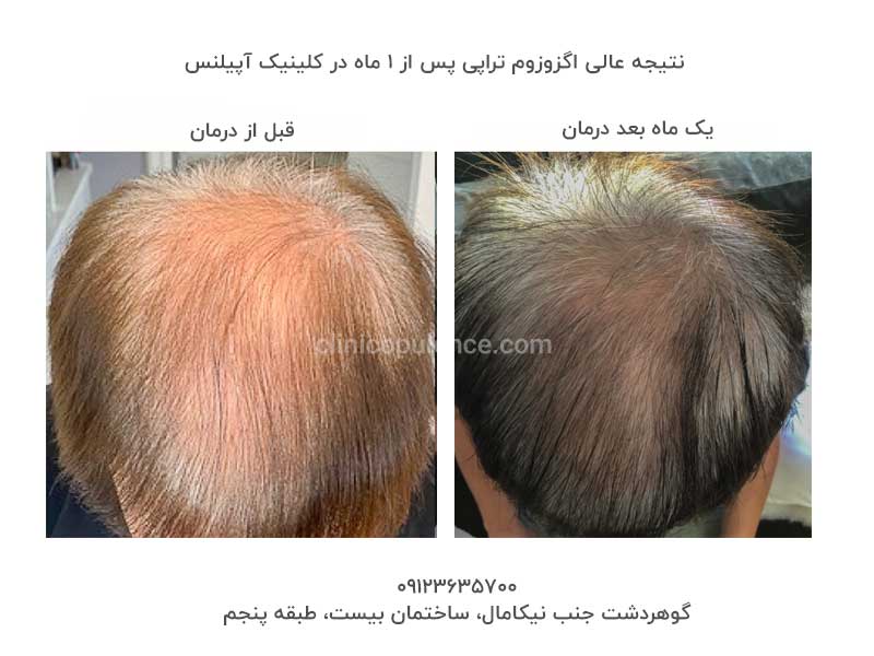 اگزوزوم تراپی برای مو رویش مجدد 