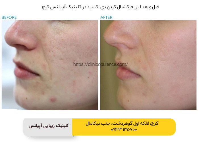 لیزر فرکشنال co2