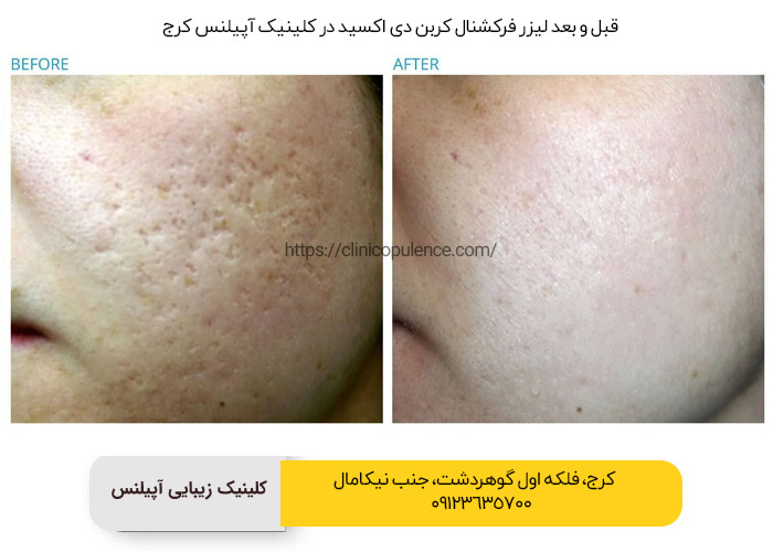 لیزر جای جوش کرج 