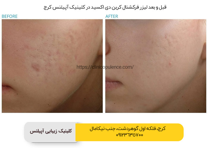 لیزر فرکشنال کربن دی اکسید کرچ هشتگرد تهران