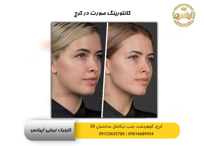 قبل و بعد کانتورینگ صورت در کرج