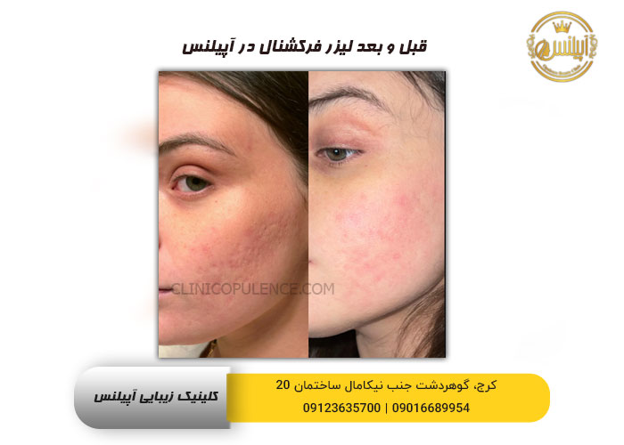 قبل و بعد لیزر فرکشنال کربن دی اکسید کرج