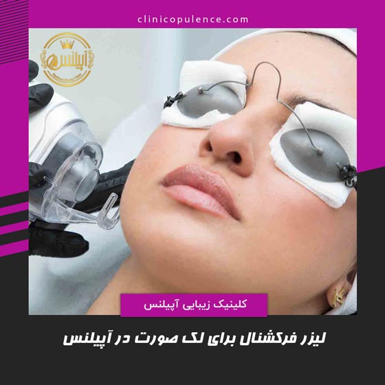 لیزر فرکشنال co2