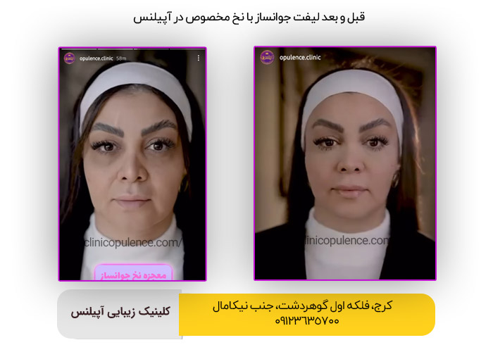 نخ لیفت جوانساز در کرج