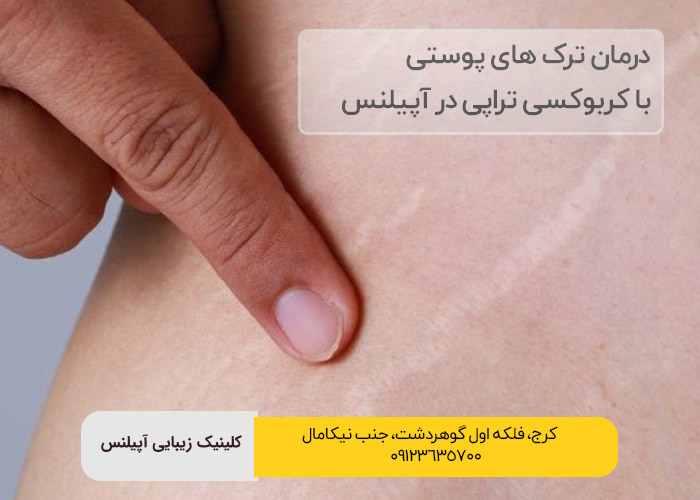 کربوکسی تراپی عظیمیه برای رفع ترک پوستی