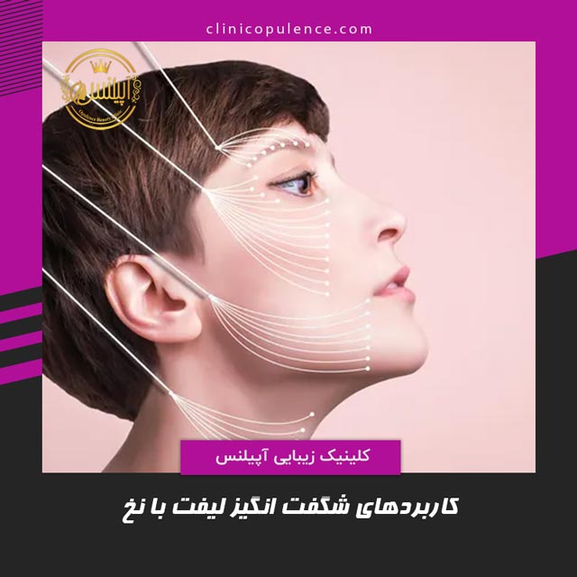 کاربرد لیفت صورت با نخ