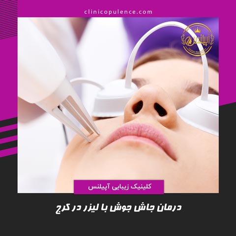 لیزر جای جوش کرج تهران co2