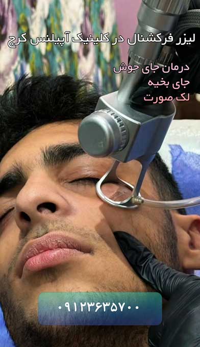لیزر فرکشنال پاک کردن جای بخیه و جوش لک در کرج تهران