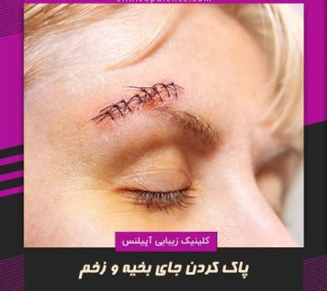 پاک کردن جای بخیه