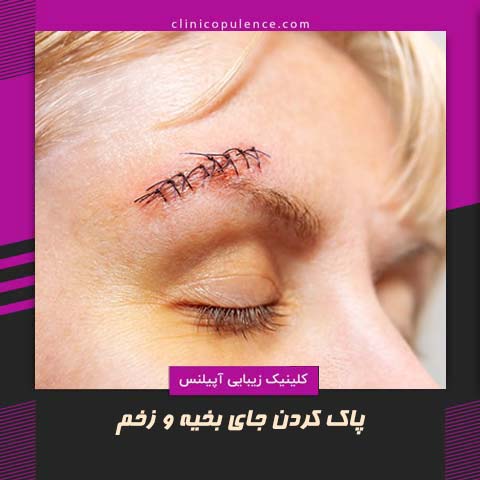 پاک کردن جای بخیه