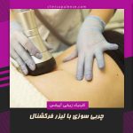 چربی سوزی با لیزر