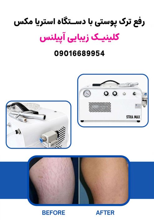 رفع ترک پوستی کرج