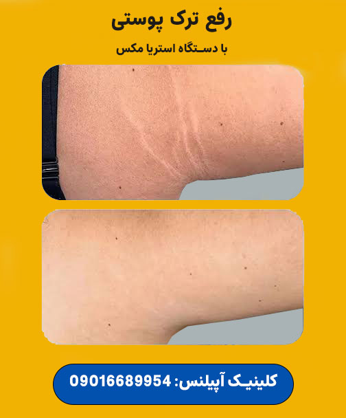 رفع ترک پوست کرج استریا