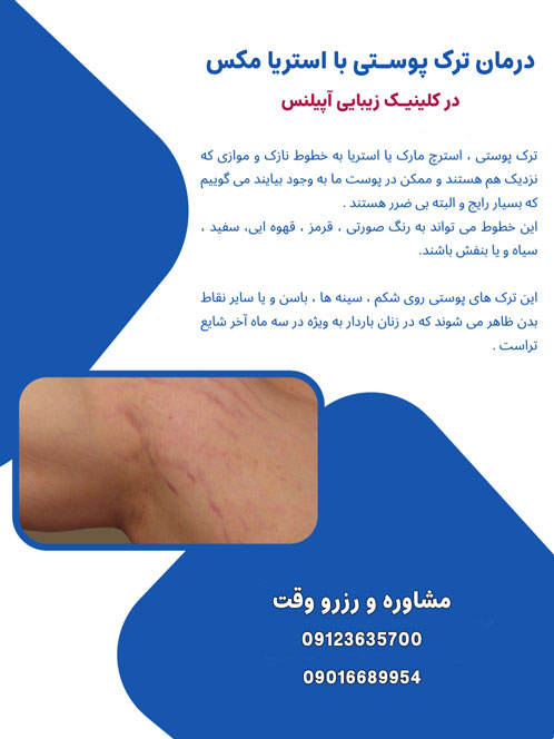 رفع ترک پوست استریا مکس